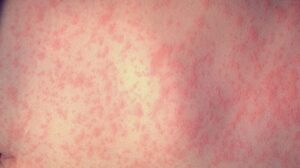 Measles Confirmed at Portland Safeway, Health Officials Warn