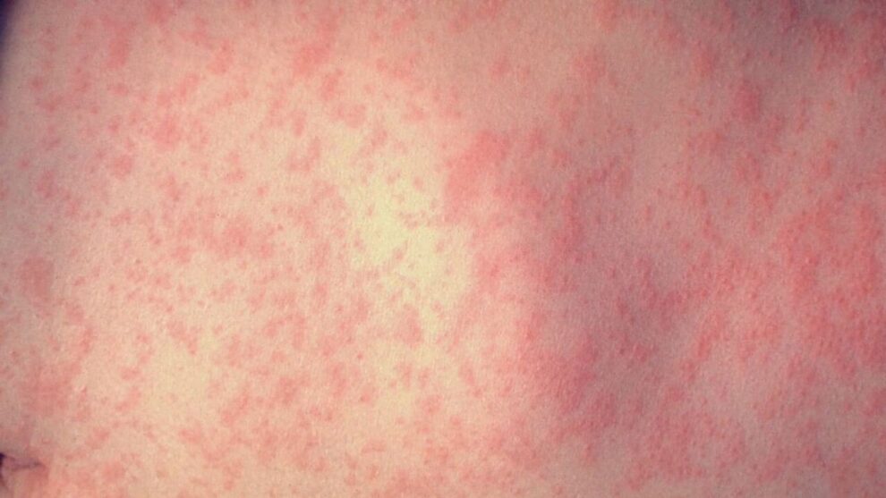 Measles Confirmed at Portland Safeway, Health Officials Warn
