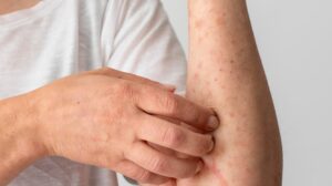 Colorado Springs Measles Exposure Warning from Health Officials