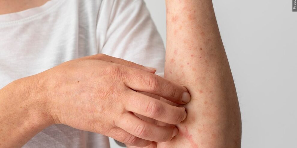 Colorado Springs Measles Exposure Warning Issued by Health Officials