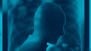 Half of Metastatic Lung Cancer Patients Miss Treatment