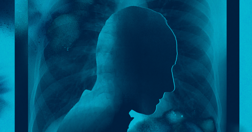 Half of Metastatic Lung Cancer Patients Miss Treatment