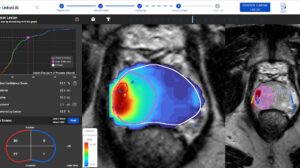 AI prostate cancer treatment at University of Michigan