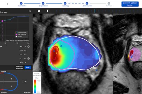 AI prostate cancer treatment at University of Michigan
