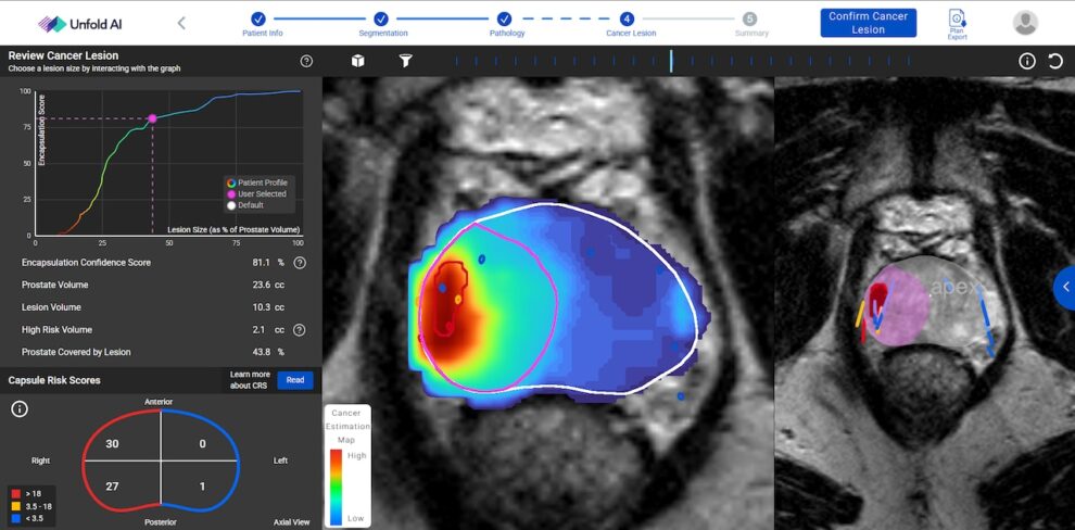 AI prostate cancer treatment at University of Michigan