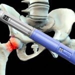 GLP-1s Reduce Fragility Fracture Risk in Diabetic Patients