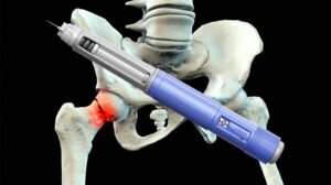 GLP-1s Reduce Fragility Fracture Risk in Diabetic Patients