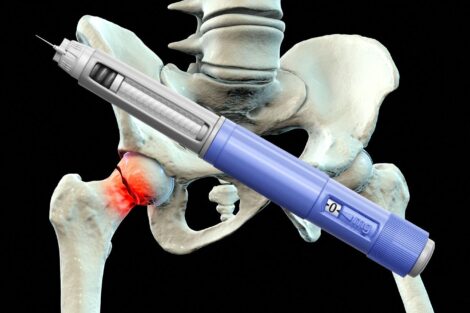 GLP-1s Reduce Fragility Fracture Risk in Diabetic Patients