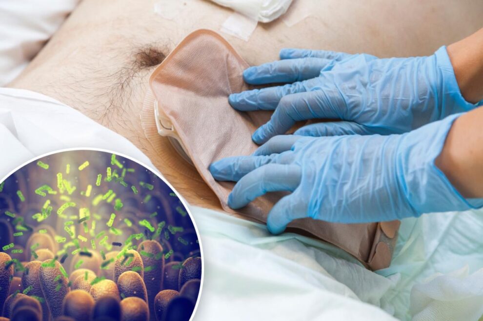 Colorectal Cancer Discovery Could Enable Earlier Diagnosis