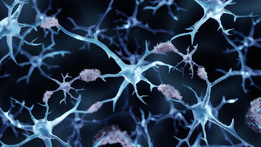 ProMIS Alzheimer's therapy shows low ARIA in trial