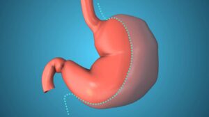 Bariatric Surgery Remains Key Despite GLP-1 Drug Boom