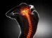 Osteoporosis drug halts spinal damage in new study
